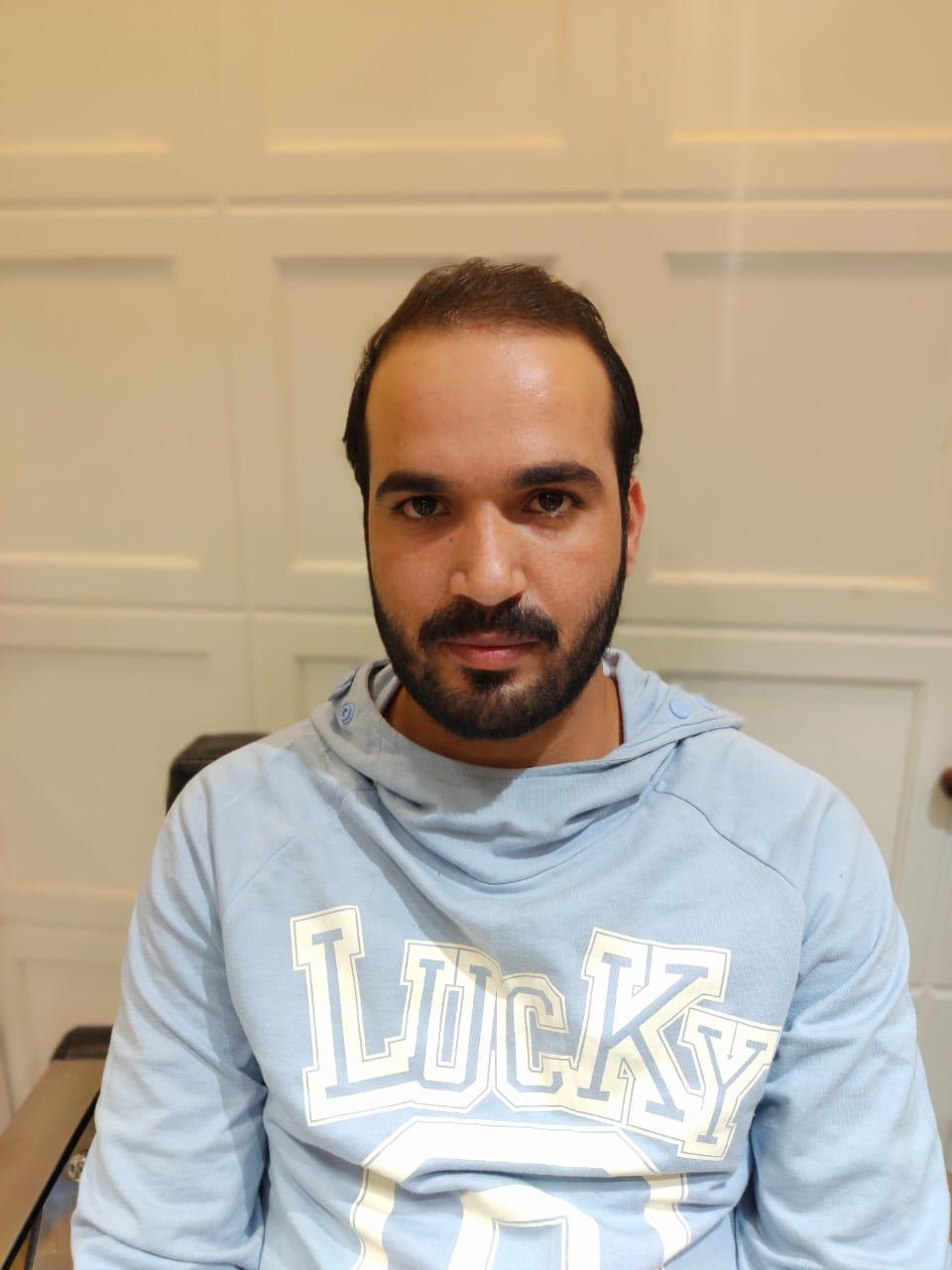 Before - Full Wig Installation